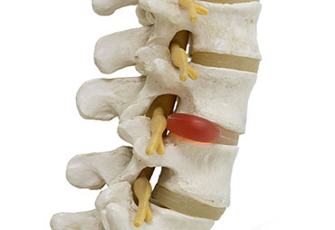 Herniated disc diagram